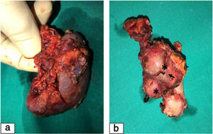 Right nephrectomy surgical specimen. (a) Right kidney significantly small for age. (b) Fragment of right renal artery with two calcified saccular aneurysms (asterisks), the larger of which was partially ruptured (arrow).