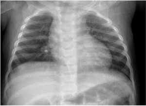 Chest radiograph. Radiopaque feature in the right perihilar area, with no signs of air trapping.