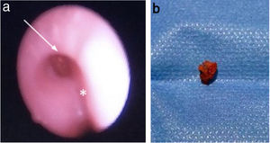 (a) Flexible bronchoscopy: foreign body (arrow) in the right bronchus (carina, asterisk). (b) Removed rubber fragment measuring 5×4mm (L×H).