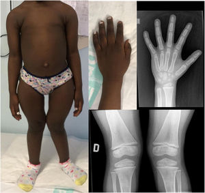 Clear radiological and deformity improvement, although some deformities remain due to the baseline severity, with persistent shortening of the lower body with coxa vara and genu valgum.