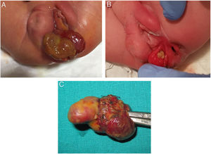 Perineal mass that had undergone exstrophy between the right outer fold of the vulva, which was hypertrophic, and the anus: (A) appearance on initial examination; (B) improved visualization of its relationship with adjacent perineal anatomic structures; (C) surgical specimen.