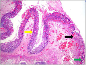 Histological appearance of the inside-out mass with anal squamous epithelium (green arrow), transitional zone (black arrow) and rectal mucosa with two layers of muscle (yellow arrow) (×4), findings consistent with the diagnosis of anorectal duplication.