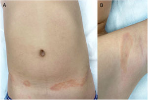 Annular plaques with a brownish erythematous border and central hypopigmentation in (A) flanks and (B) axillae.