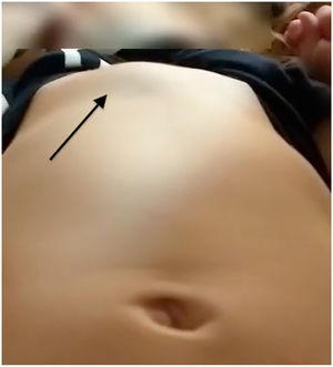 Tumour with a solid consistency in the lower third of the sternum (arrow).