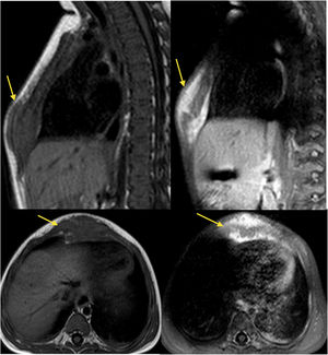 T1-weighted MRI, pre- and post-gadolinium: sagittal and axial views showing a lesion of the soft tissues surrounding the distal sternum with uptake of contrast.