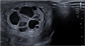 Testicular ultrasound scan: multicystic septate lesion.