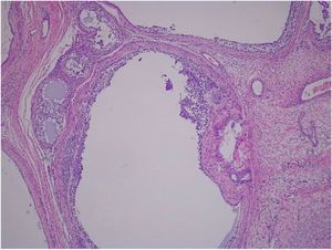 Histological examination: follicular pattern lined with granulosa cells.