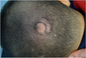 Collar of hypertrophic hair surrounding a bulging bald patch soft to the touch.