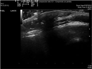 B-mode ultrasound image. Continuity of the tables of the skull with an overlying hypoechoic area.
