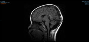 Magnetic resonance imaging. Small bone suture defect in the occipital midline and hypointense communication in the location of the scalp lesion.
