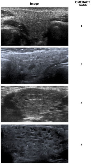 Ultrasound features characteristic of the changes found in the salivary glands of patients with juvenile Sjögren syndrome. All images are of the submandibular gland, and the abnormalities were bilateral. The assessment of the changes on a scale from 0 to 3 was performed using the Salivary Gland Ultrasound Scores (SGUS), a scoring system developed by Outcome measures in Rheumatology (OMERACT) to measure sonographic salivary gland abnormalities in patients with Sjögren syndrome. The analysed variables include the inhomogeneity of the parenchyma, the presence of anechoic/hypoechoic areas (micro- or macrocysts) and the echogenicity of the surrounding tissue (normal or fibrotic).