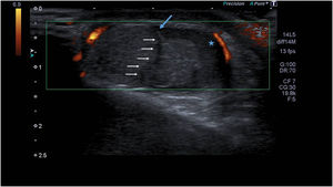 Preoperative ultrasound of the scrotum showing mild enlargement of the right testicle with heterogeneous echotexture in the parenchyma, contour abnormality and discontinuity of the tunica albuginea (blue arrow), absence of intratesticular fluid and haematocele (star). The white arrows point to the testicular rupture line.