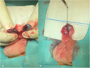Intraoperative findings. (A) Complete rupture at the level of the middle third of the testicle and the epididymis in the transversal plane, with adequate perfusion in both segments. (B) Outcome after surgical repair.