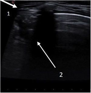 Lung ultrasound, fourth intercostal space at the midclavicular line. Unstructured pleura (arrow 1), with a consolidation pattern (arrow 2) and irregular margin (shred sign) occupying an intercostal space with a depth of 1.2 cm, compatible with incipient pneumonia.