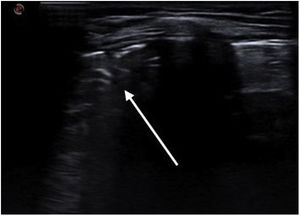 Lung ultrasound. Same consolidation pattern with bronchogram (arrow).