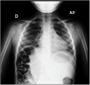 Posteroanterior chest radiograph. Visualization of the bowel loops interposed between the diaphragm and liver, which is displaced toward the midline. No features of consolidation.
