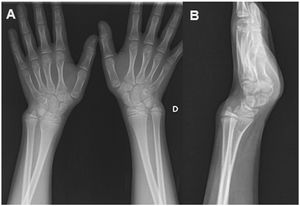 Anteroposterior radiograph of both wrists (A) and lateral radiograph of left wrist (B) showing deviation of the distal growth plate of the radius and a V-shaped carpus.