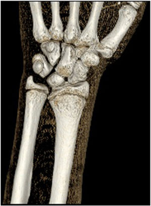 Left wrist 3D computed tomography scan showing dorsal deviation and subluxation of the distal ulna with mild bowing and shortening of the distal diaphysis of the radius and the triangular shape of the semilunar bone (observed in both wrists).