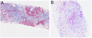 Histological examination of the pancreas. (A) Image with ×10 magnification showing fibrosis (Masson’s trichrome stain). (B) Image with ×20 magnification showing polymorphonuclear neutrophil infiltration of pancreatic ducts (haematoxylin and eosin stain).