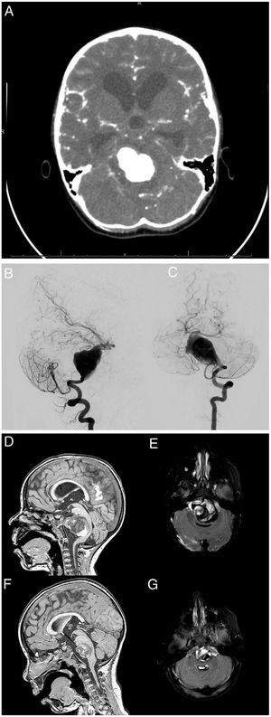 (A) The CT scan showed subarachnoid haemorrhage and obstructive hydrocephalus. Cerebral angiogram. Left vertebral artery series: (B) lateral view and (C) anteroposterior view. Giant fusiform aneurysm in the two lower thirds of the basilar artery. Treatment options like parent artery sacrifice or stent-assisted reconstruction were ruled out on account of the age of the patient and anatomical considerations. T1-weighted and FLAIR (fluid-attenuated inversion recovery) MRI images: (D) and (E) immediate postoperative period, and (F) and (G) 6 months after surgery. The images show a progressive reduction of the aneurysmal pouch and partial resolution of mass effect and obstructive hydrocephalus.
