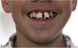 General appearance of the mouth opening of the patient.