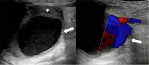 Popliteal artery aneurysm (arrow) with a mural thrombus in the posterior aspect (asterisk) and adequate distal arterial blood flow.