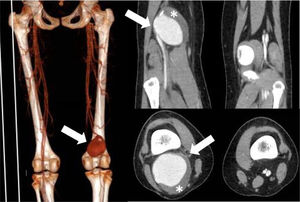 Aneurysm measuring 5.7×5×7.6cm (arrow), with thrombus (asterisk) and mural calcifications. Patent tibioperoneal trunk, without indirect signs of thrombosis. No other visible aneurysms.