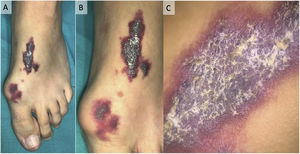 Naked-eye and dermoscopic appearance of the lesions.