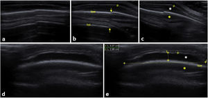 (a–c) Longitudinal scan with high-frequency linear probe (LSHFLP) on the left parietal region. Discontinuity in the cortex of both bones (arrows) suggestive of parietal bone fracture, and ipsilateral perilesional cephalohaematoma (white asterisk [*]). (d) LSHFLP at the level of a mass in the right parietal bone, which had appeared several days before in a newborn, showing cephalohaematoma with subperiosteal blood collection. (e) Scan of similar characteristics to the previous one with measurement of the length and width of the cephalohaematoma and identification of the different structures. Yellow asterisk (*): mirror image artifact of the cephalohaematoma. p, periosteum; toe, external surface; toi, internal surface.