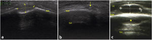 (a) LSHFLP of a mass at the level of the left occipitotemporal suture, non-moveable and hard, in a girl aged 2 years with no reported history of trauma. Cystic appearance imprinted on the external bone surface, compatible with dermoid cyst. (b) LSHFLP of a small stony-hard mass in the right superciliary region of a boy aged 3 years: hypoechoic cystic lesion with hyperechoic centre, compatible with calcifying epithelioma of Malherbe or pilomatrixoma (arrow). (c) LSHFLP of a small, moveable slightly hard mass at the level of the right occipital region in a boy aged 3.5 years: hypoechoic cystic pattern compatible with reactive lymphadenopathy. Yellow asterisk (*): lymph node mirror image artifact; cc, scalp; toe: external surface; toi: internal surface.