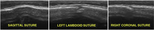 LSHFLP at the level of the different skull sutures in a patient aged 7 months with a sonographic diagnosis of scaphocephaly: prominent sagittal suture with premature fusion compared to the rest of the sutures, which are still open.