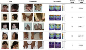 Facial features and limb abnormalities in patients with CdLS and pathogenic variants in different causative genes. The figure also shows the analysis made with the Face2Gene software and the scores calculated using the criteria proposed by Kline et al.3
