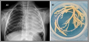 (A) Complete opacification of left hemithorax due to massive lung atelectasis with hyperinflation of the contralateral lung. (B) Bronchial casts removed during flexible bronchoscopy.