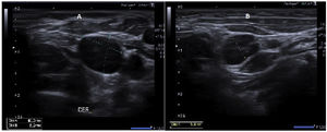 Ultrasound examination: (A) Right internal jugular vein upon performance of the Valsalva manoeuvre, measuring 8.2 × 10.3 mm. (B) Left jugular vein at rest, with a maximum diameter of 5.8 mm.