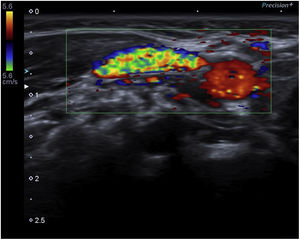 Colour Doppler ultrasound: evidence of venous flow and absence of intraluminal thrombi.