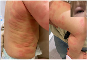 Generalised exanthema and palpebral oedema.