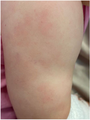 Disseminated petechiae.