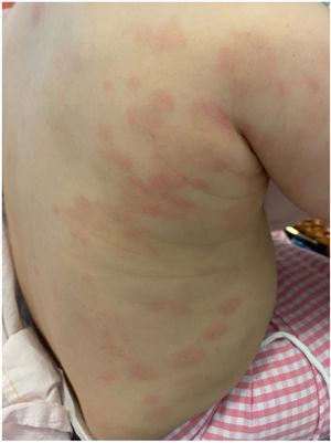 Outcome of exanthema.