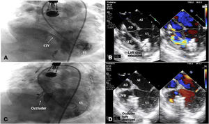 Percutaneous closure procedure. (A) Preoperative angiogram showing the muscular defect and flowing of contrast into the right cavities (arrows). (B) Transoesophageal echocardiogram 4-chamber view showing the release of the retention disc of the device. (C) Angiogram after the release of the device. (D) Transoesophageal echocardiogram 4-chamber view after implantation of the device showing mild residual shunt. LA, left atrium; LV, left ventricle; RA, right atrium; RV, right ventricle; VSD, ventricular septal defect.