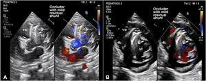 Transthoracic echocardiogram (A) 4-chamber view and parasternal short axis view (B) 4-chamber view and follow-up echocardiogram 1 year after the procedure showing a mild residual shunt. LA, left atrium; LV, left ventricle.