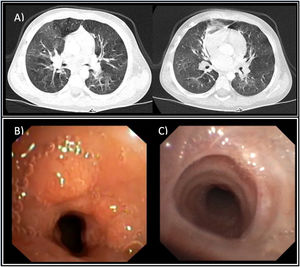 (A) Lung computed tomography scan: bilateral mosaic attenuation pattern compatible with bronchiolitis obliterans. (B) Flexible bronchoscopy: tracheal stenosis with reduction of 60% to 70% of the tracheal lumen due to granuloma. (C) Flexible bronchoscopy, 3 months after image B: residual membrane after steroid therapy and dilations.