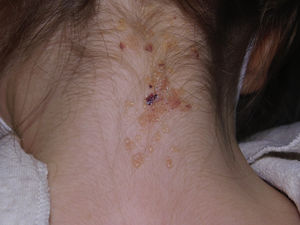 Beginning of treatment.