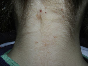 A year and a half after finishing treatment.