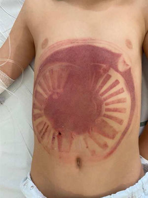 Ecchymoses with the appearance of the suction drain cover imprint.