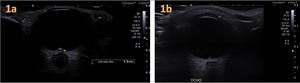 (a) Ocular ultrasound of the left optic disc on day 1 of the stay. The 1.5 mm elevation/protrusion of the optic disc exceeded the proposed 0.6 mm threshold for the suspicion of IICP and even the stricter threshold of 1 mm for confirmed IICP and the revised range for papilloedema (0.6–1.2 mm).2 (b) Follow-up ultrasound scan at 5 days after initiation of treatment and clinical improvement, without visualization of optic disc protrusion.