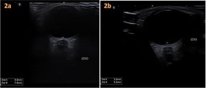 (a) Measurement of the diameter of the left optic nerve sheath (ONS) (7 mm) adjacent to the protruding optic disc. (b) Measurement at 5 days of treatment that evinced a decrease in the ONS diameter (5 mm) and the size of the optic disc.