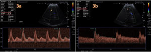 (a) Transcranial Doppler ultrasound of the flow of the left middle cerebral artery through the transtemporal window at diagnosis. Abnormal waveform at baseline, with a pulsatility index (PI) of 2.1 and a resistive index (RI) of 0.78, suggestive of IICP. (b) Measurement at 5 days of treatment with changes in the waveform and a decrease in both indices (PI, 1.38; RI, 0.67).