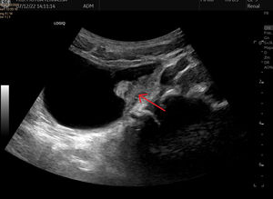 Sonogram with visualization of a parietal lesion with well-demarcated borders in the left inferolateral surface of the bladder.