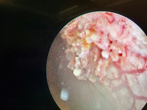 Cystoscopy view of the larger lesion in the left inferolateral surface of the bladder. Papillary appearance with vascular channels.