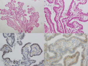 Histological examination. Papillary fronds lined with cuboidal epithelium with eosinophilic cytoplasm and smudged chromatin nuclei (haematoxylin-eosin stain, ×20 magnification on top left and ×40 on top right). Positive staining for α-methylacyl-CoA-racemase (bottom left) and PAX8 (bottom right).